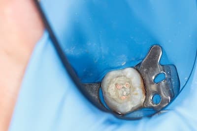 ADEE Atención Dental Especializada en Endodoncia