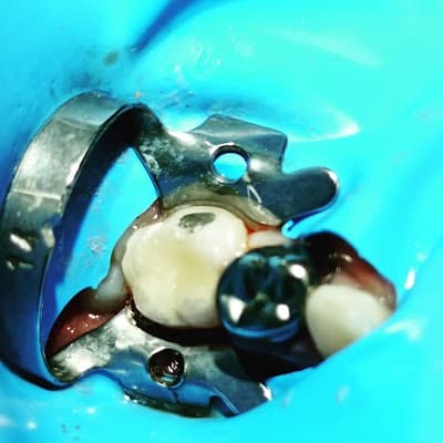 Brijedent dentista de niños y adultos con ansiedad dental d up Ecatepec