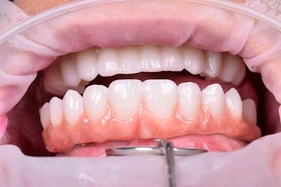 Enamelex Clinica Dental rosarito