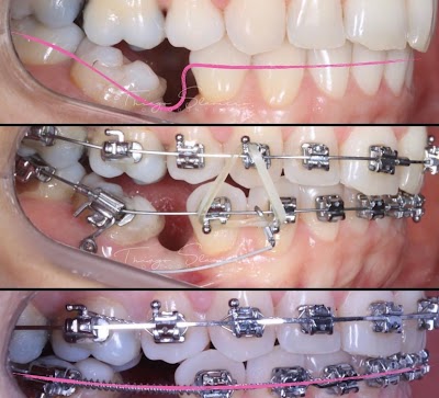 Dental bracket